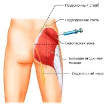 Як зробити укол у сідницю в домашніх умовах зробити