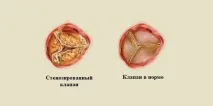 Кальциноз аортального клапана. клапана