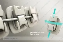 Керамічні брекети переваги, недоліки, популярні марки, встановлення, догляд керамічні