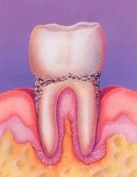 Tratamentul parodontitei (Tratamentul inflamației rădăcinii dintelui)