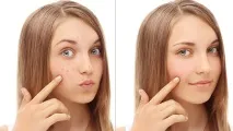 Лікування вугрової хвороби, ОК клініка на Бочарова хвороби
