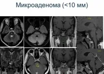 микроаденом