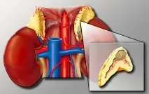 Simptomele tumorii glandelor suprarenale și metode de diagnostic
