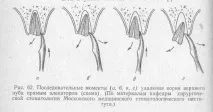 Перелом зуба причини, види, симптоми, лікування перелом