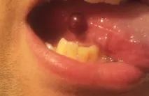 свищ