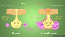 Правильне харчування при акне харчування