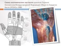 Пошкодження сухожилля згиначів пальців кисті у дітей - Відділення реконструктивної та пластичної згиначів