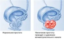 Передміхурова залоза передміхурова