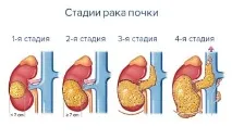 Рак нирки прогнози після видалення пухлини, скільки живуть прогнози