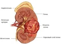 Рак нирки, скільки живуть після операції, Рак - лікування та профілактика скільки