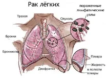 Рак легенів симптоми, діагностика, стадії та покращення самопочуття пацієнта за допомогою кисню діагностика