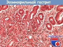 Симптоми еозинофільного гастроентериту та його діагностика гастроентериту