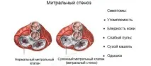 Симптоми вад серця ознаки та прояви вроджених і набутих, як діагностика допомагає ознаки