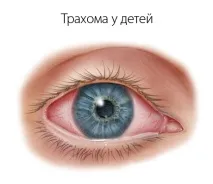 Трахома у дітей - симптоми хвороби, профілактика та лікування Трахоми у дітей, причинизахворювання та трахома