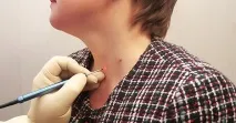 Видалення бородавок лазером чи ефективно лазером