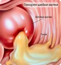 Хламідійна інфекція у чоловіків, жінок та дітей симптоми та лікування при вагітності хламідійна