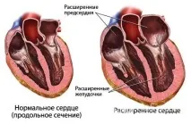 Хронічна серцева недостатність – лікування, класифікація лікування