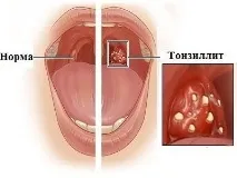 хронічний