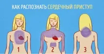 Серцевий напад симптоми у жінок та чоловіків, перша допомога перша