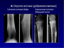 Остеома стегнової кістки симптоми, ознаки та лікування стегнової