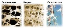 Остеопенія - симптоми, лікування та профілактика остеопенія