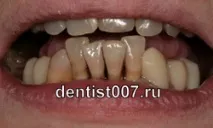 зубів