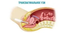 Перфорація матки причини, симптоми, діагностика, лікування перфорація