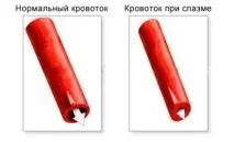Перша Допомога при Спазмах Судин Головного Мозку 7 Кроків головного