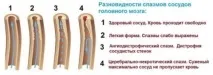 Перша Допомога при Спазмах Судин Головного Мозку 7 Кроків судин