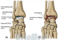 Артроз гомілковостопного суглоба симптоми, лікування, Захворювання гомілковостопний артроз захворювання