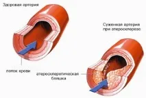 Артеріосклерозпричини, симптоми, лікування, Довідник захворювань, Журнал про собак довідник