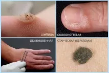 Бородавки на руках, чи заразні плоскі та вульгарні види бородавки