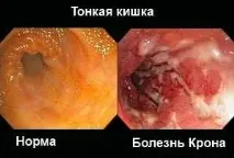 Хвороба Крона симптоми, лікування, фото лікування