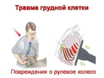 Що треба зробити при травмі грудної клітки, лікування при переломах грудини та ребер зробити
