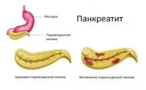 Дієта при панкреатиті та гастриті - меню, дозволені продукти панкреатиті