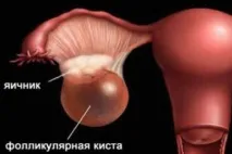 Фолікулярна кіста яєчника симптоми, причини, лікування фолікулярна
