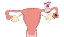 Після затримки убогі місячні чи можлива вагітність після