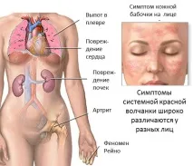 Як лікувати системний червоний вовчак, його симптоми та небезпека системний