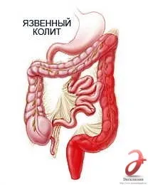 Лікування коліту в Санкт-Петербурзі - ціни, відгуки відгуки