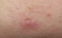 La Roche-Posay, Як позбутися прищів позбутися