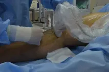 Лікування варикозу лазером у Мінську, ціни на ЕВЛК у Мінську, операція лазером лазером