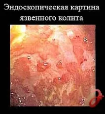 Лікування коліту в Санкт-Петербурзі - ціни, відгуки коліту
