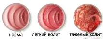 Лікування коліту в Санкт-Петербурзі - ціни, відгуки ціни