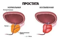 Ознаки простатиту у чоловіків під які захворювання маскується, Правильна контрацепція захворювання