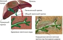 Ускладнення панкреатиту класифікація та способи попередження класифікація