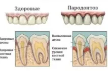 пародонтоза