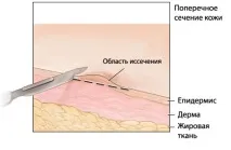 Портал про рак біопсії