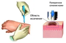 Портал про рак біопсії