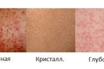 Пітниця під грудьми пітниці