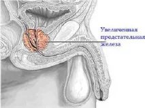 простатит